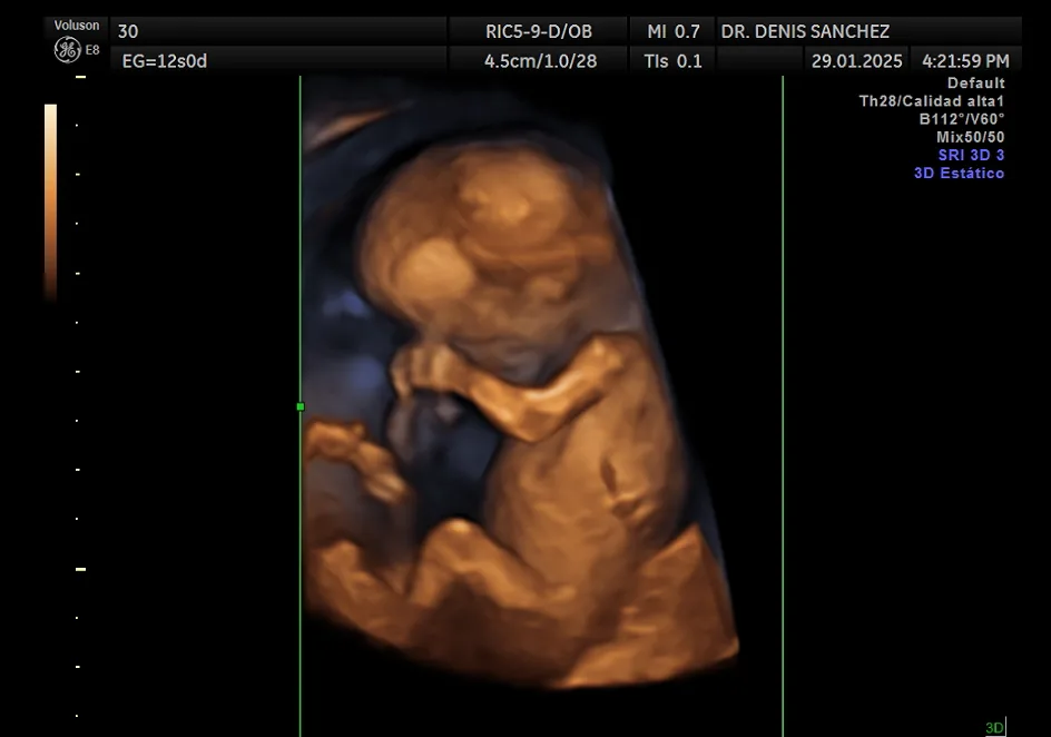 Ecografía cromosómica y morfológica o anatómica