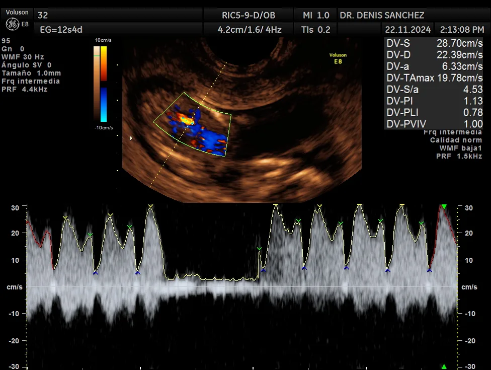 Ecografía doppler obstétrica