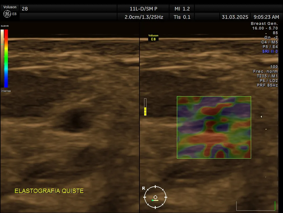 Ecografía mamaria Quito