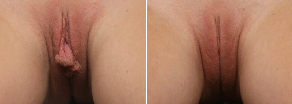 Labioplastia Láser en Quito con el Dr. Denis Sánchez