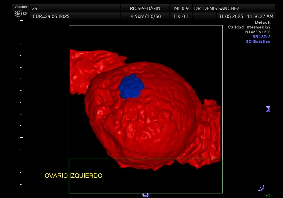 Quiste ovárico observado con tecnología 3D en el consultorio del Dr. Denis Sánchez