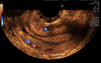 Engrosamiento endometrial en ecografía: causas, valores normales y diagnóstico diferencial
