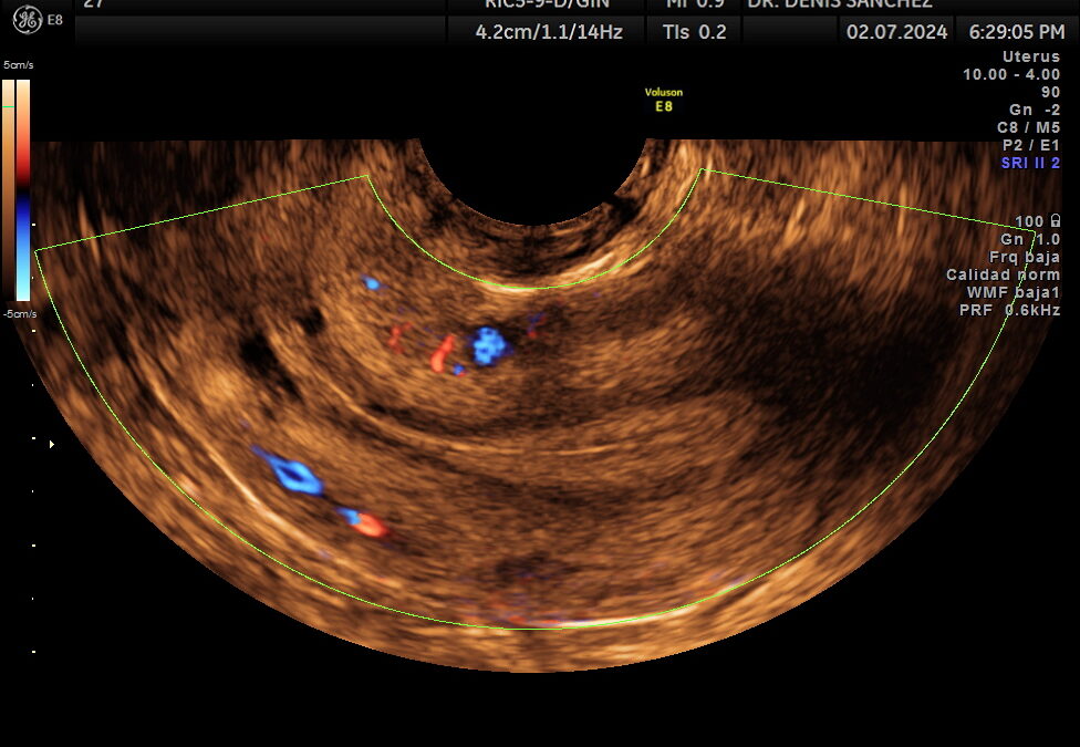 Imagen de ecografía transvaginal de un útero a propósito del engrosamiento endometrial