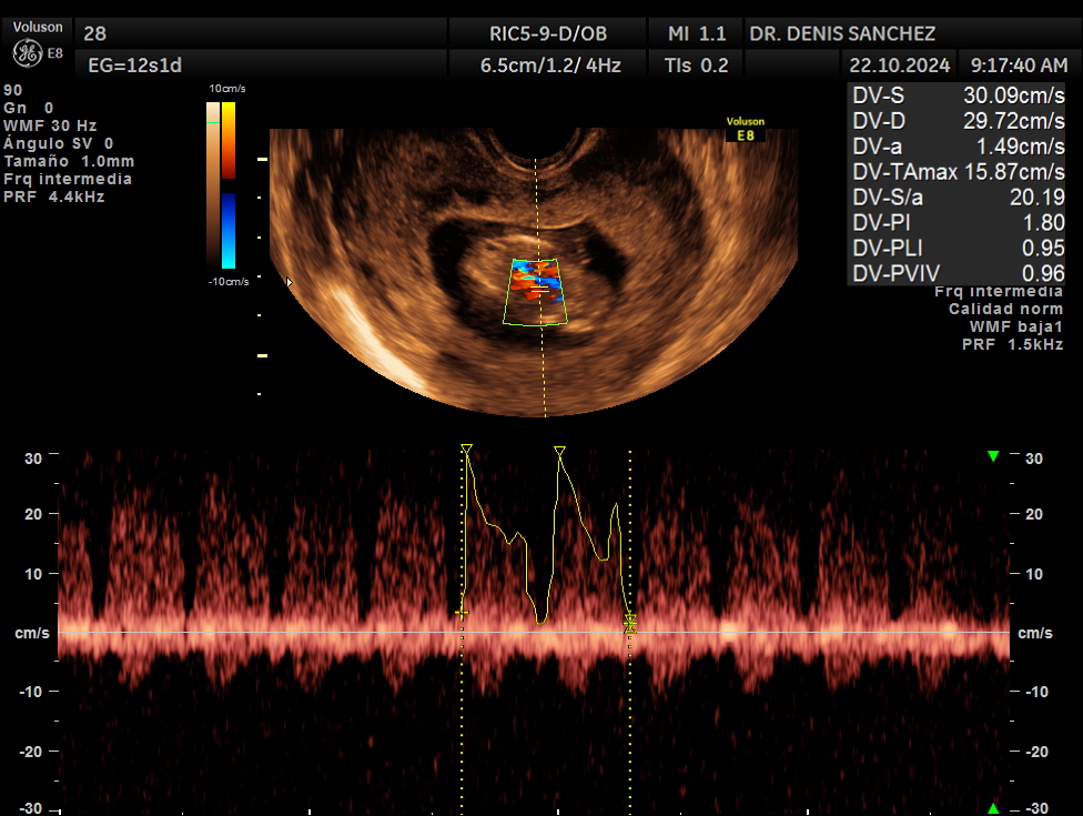 Ecografía Doppler del ductus venoso fetal realizada durante una ecografía cromosómica del primer trimestre por el Dr. Denis Sánchez en Quito, mostrando la onda de flujo y parámetros velocimétricos.