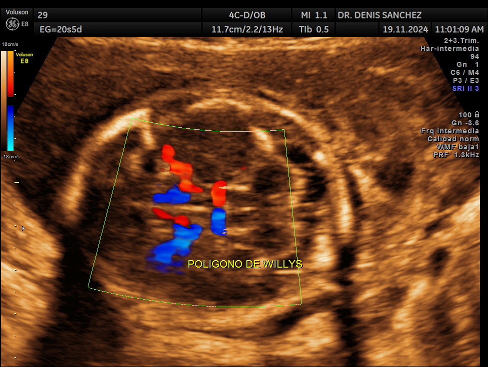 Ecografía Doppler fetal del segundo trimestre realizada por el Dr. Denis Sánchez en Quito, mostrando el polígono de Willis y la irrigación cerebral durante el estudio anatómico o morfológico del bebé.