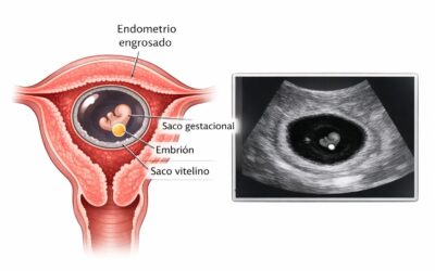 ¿Endometrio engrosado en embarazo? Sí, puede ser normal… pero depende de la ecografía y los síntomas